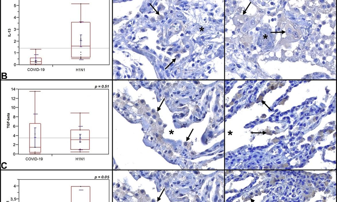 Fibrose pulmonar